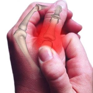 Arthritis Pain
